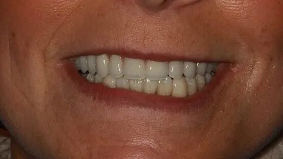 بعد علاج الأسنان