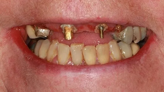 قبل علاج الأسنان